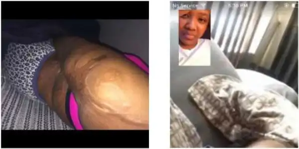 "They call you beautiful but act differently when they see your scars" Burn survivor writes